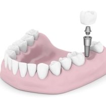 Dental implants