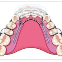 Teeth Straightening Procedure
