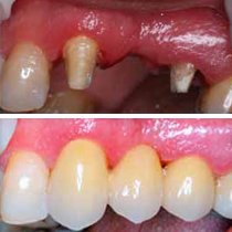 Dental Bridges