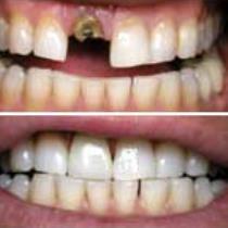 Dental Crowns Procedure