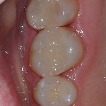 Dental White Fillings